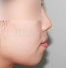 鼻子、下巴注射玻尿酸整形前后对比照片