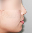 鼻子、下巴注射玻尿酸整形前后对比照片术后