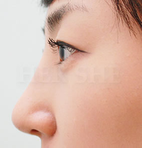 鹰钩鼻矫正术对比案例