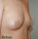 无手术无痛症的丰胸整形前后对比照片术前