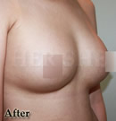 无手术无痛症的丰胸整形前后对比照片术后
