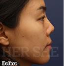鼻部综合整形对比案例