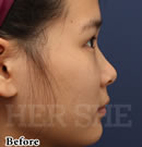 line鼻部整形对比案例术前