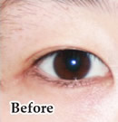 双眼皮部分切开手术前后对比照片