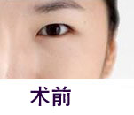 北京清木整形眼部手术