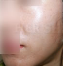 注射PRP改善皮肤斑痕案例对比术后