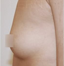 果冻义乳隆胸整形前后对比照片
