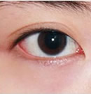 韩式双眼皮手术前后对比照片
