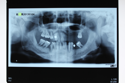 缺牙保安赵先生口腔情况拍片图片