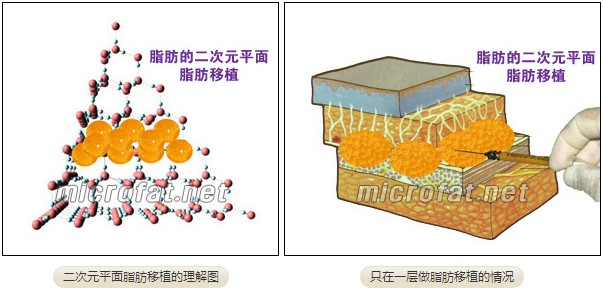 二次元平面脂肪移植