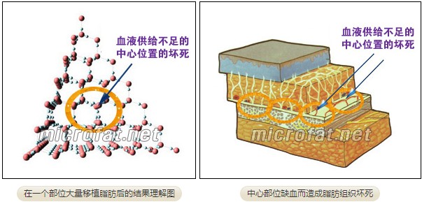 在一个部位进行大量脂肪移植的结果