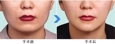 韩国ID整形医院做V型脸整形手术要多少钱