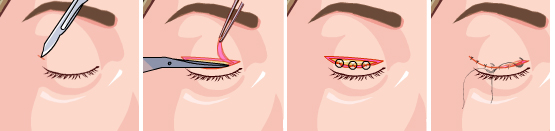 双眼皮手术过程示意图