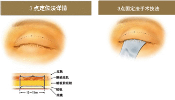 韩式三点双眼皮手术