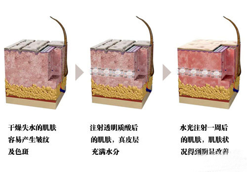 水光注射后肌肤状态示意图