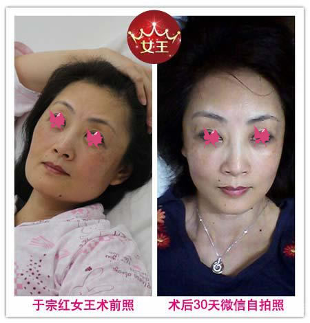 广州博仕整形女王于宗红前后对比照片