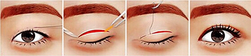 肿泡脂肪型双眼皮手术方法