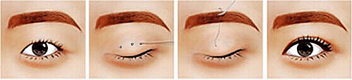 普通单睑型双眼皮手术方法