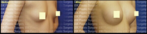 BK整形医院的隆胸案例图