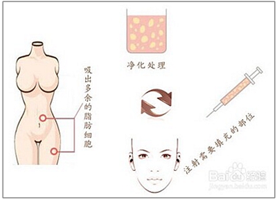 郑州丽天的自体脂肪童颜术原理示意图