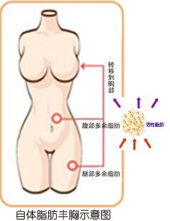 北京惠美整形做隆胸手术安不安全