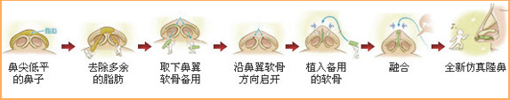 3D无痕仿生隆鼻手术过程