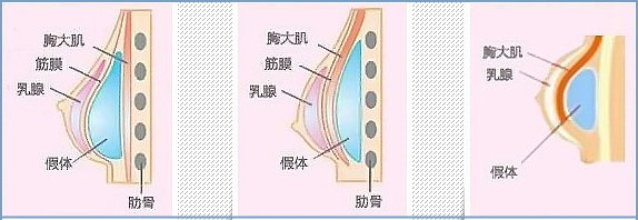 南昌佳美整形做假体隆胸怎么样呢