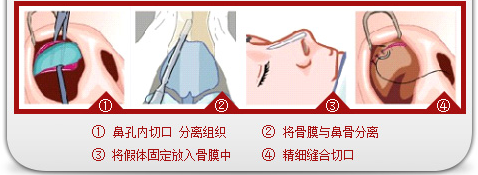 广州粤美的数字化鼻整形好在哪里