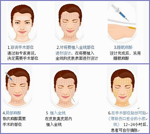 金线除皱手术步骤