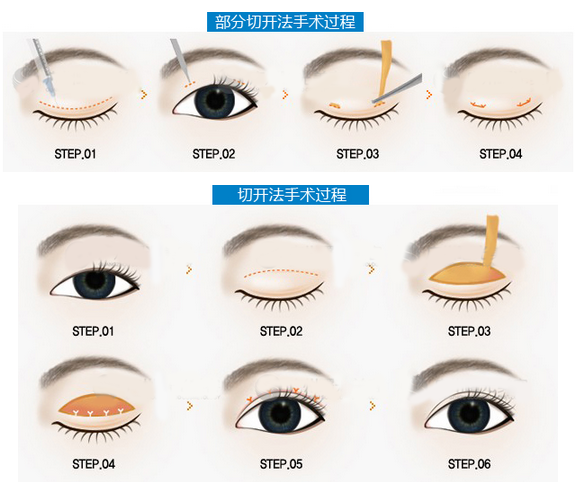 广州曙光整形做切开双眼皮的两种手术图例