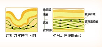 定点注射