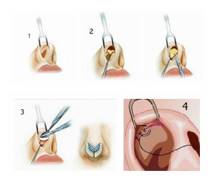 鼻部整形手术过程