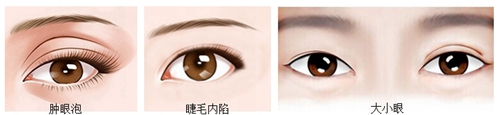 TAT双眼皮可改善的眼部问题