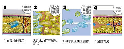 水动力吸脂手术过程