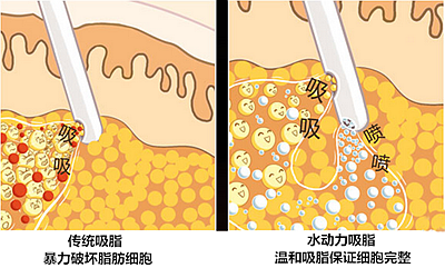 水动力小腿分层溶脂和传统吸脂的区别