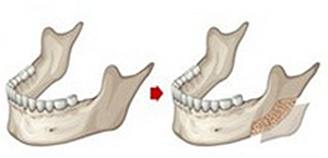 下颌角磨骨手术