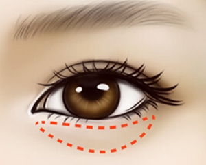 眼袋就是指下眼睑浮肿，眼袋的出现与加重是面部衰老的标志之一