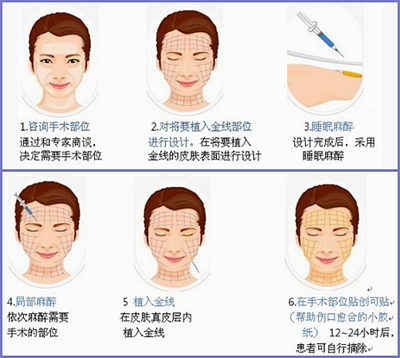 金线除皱手术过程