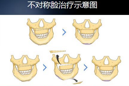 爱思特正颌手术