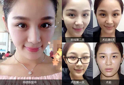 爱思特单眼皮脱单季——灵韵精雕大眼术(特价)