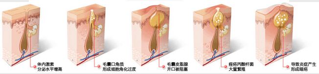 4D激素冰疗+EPO+复合彩光