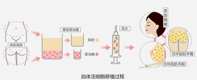 福州华窈整形自体活细胞移植术