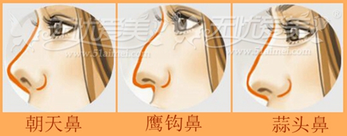 深圳希思做隆鼻手术效果怎么样呢