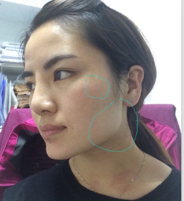 上海华美颧骨手和颌角手术经历