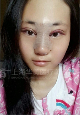 上海华美做双眼皮、隆鼻的经历