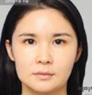韩国伊美芝下颌角截骨手术案例