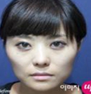 韩国伊美芝面部轮廓，颧骨缩小手术案例
