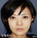 韩国伊美芝面部轮廓，颧骨缩小手术案例