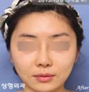 韩国伊美芝歪脸矫正手术案例