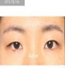 韩国伊美芝双眼皮手术案例